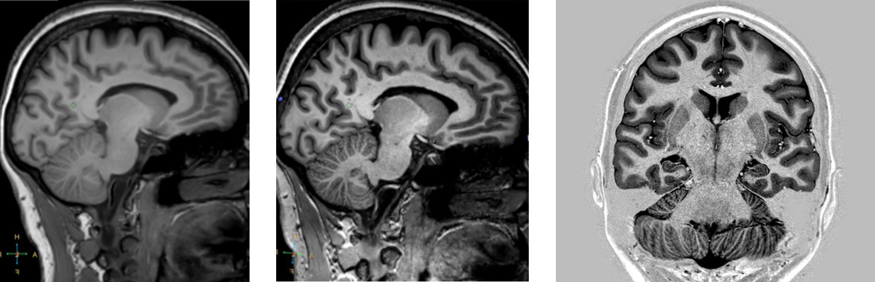 La Resonancia Magn tica Cerebral Como Herramienta De Investigaci n La Resonancia Magn tica Cerebral Como Herramienta De Investigaci n
